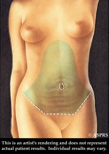 abdominoplasty target, abdominoplastie zone cible